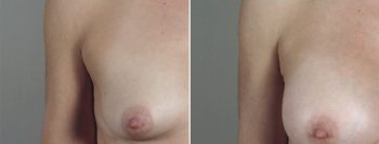 Breast Enlargement (Augmentation) Patient 84