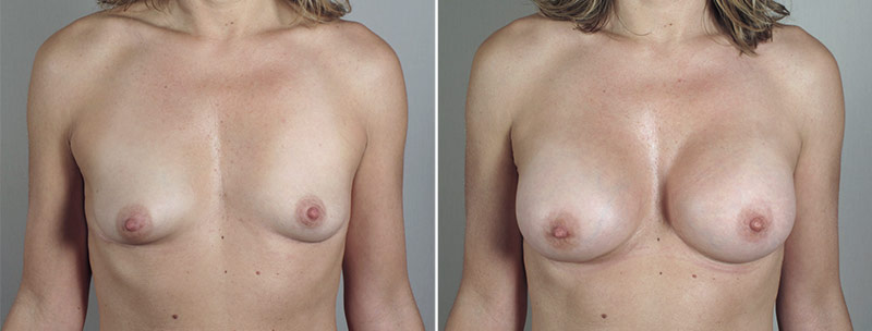 Breast Enlargement (Augmentation) Patient 84