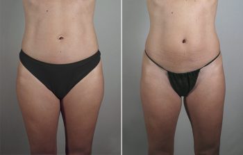 Breast Enlargement (Augmentation) Patient 84