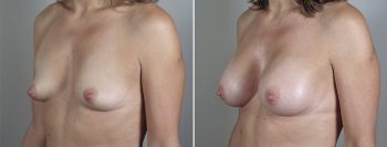 Breast Enlargement (Augmentation) Patient 84
