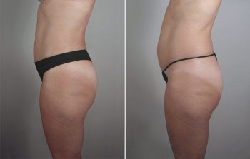 Breast Enlargement (Augmentation) Patient 84