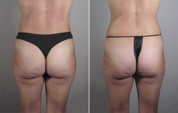 Breast Enlargement (Augmentation) Patient 84