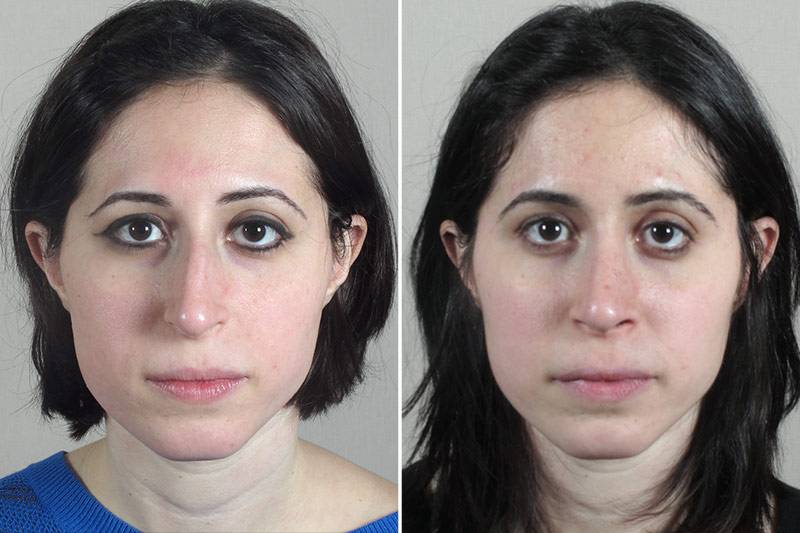 Rhinoplasty Patient 51