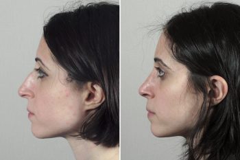 Rhinoplasty Patient 51