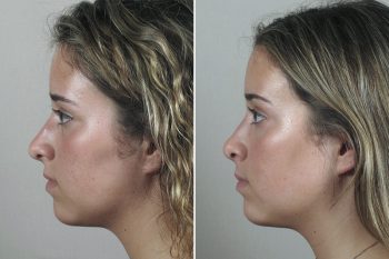 Rhinoplasty Patient 52