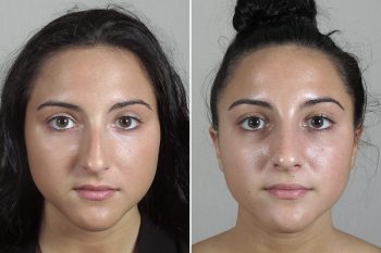 Rhinoplasty Patient 53