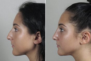 Rhinoplasty Patient 53