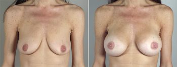 Breast Enlargement (Augmentation) Patient 85