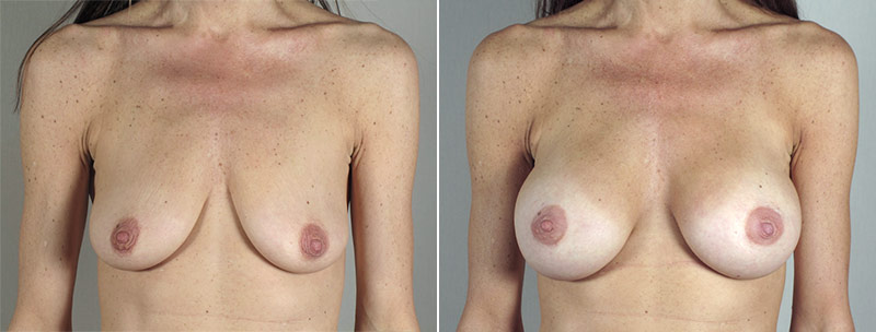 Breast Enlargement (Augmentation) Patient 85