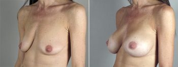 Breast Enlargement (Augmentation) Patient 85