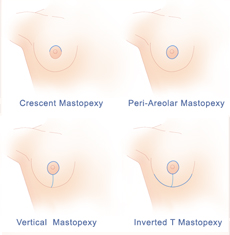Options for Breast Lift Surgery New Jersey