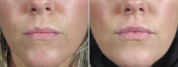 Angela’s Patient 11- Filler