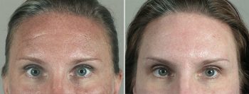 Angela’s Patient 15 – Dysport