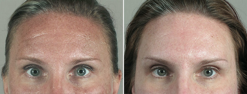 Angela’s Patient 15 – Dysport