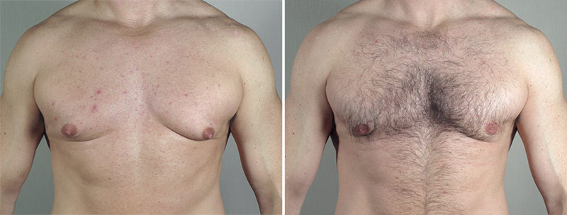 Gynecomastia Reduction Patient 48