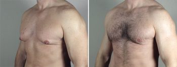 Gynecomastia Reduction Patient 48