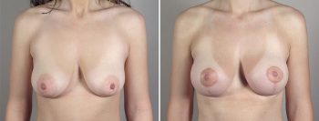 Breast Lift with Implants Patient 37