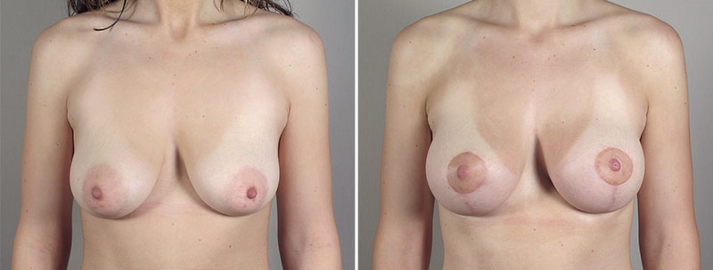 Breast Lift with Implants Patient 37