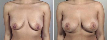 Breast Lift with Implants Patient 38