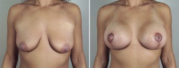 Breast Lift with Implants Patient 39