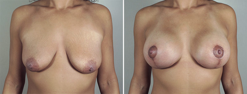 Breast Lift with Implants Patient 39
