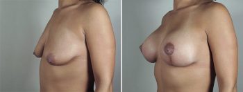 Breast Lift with Implants Patient 39
