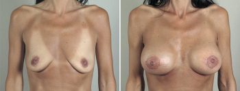 Breast Lift with Implants Patient 40