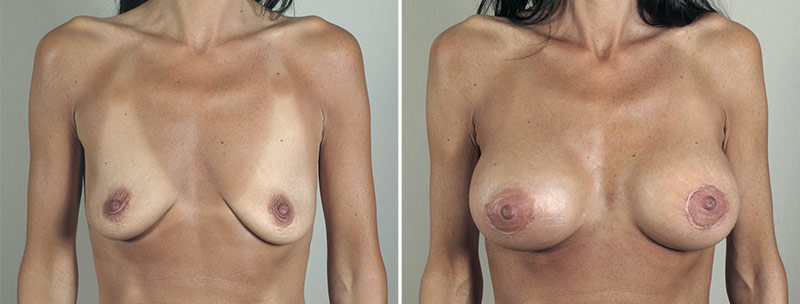 Breast Lift with Implants Patient 40
