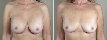 Breast Implant Removal Patient 28