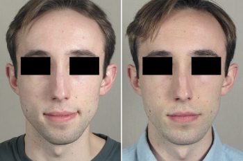 Chin Implant Patient 18