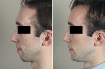 Chin Implant Patient 18