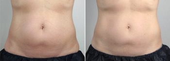 CoolSculpting Patient 01