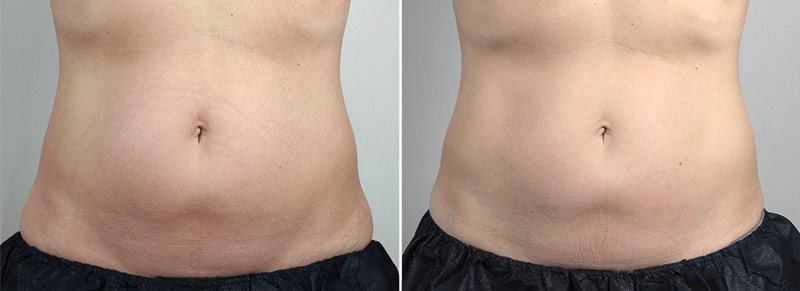 CoolSculpting Patient 01