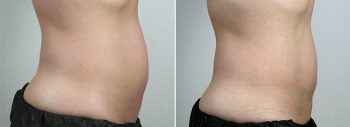 CoolSculpting Patient 01