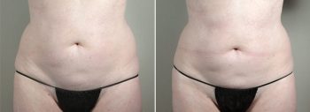 CoolSculpting Patient 02