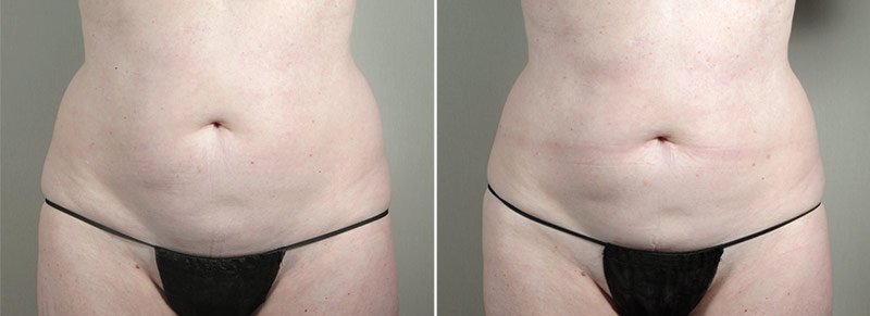 CoolSculpting Patient 02