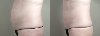 CoolSculpting Patient 02
