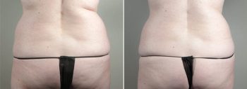 CoolSculpting Patient 02