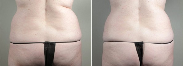 coolsculpting New Jersey