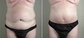 Male Abdominoplasty Patient 9