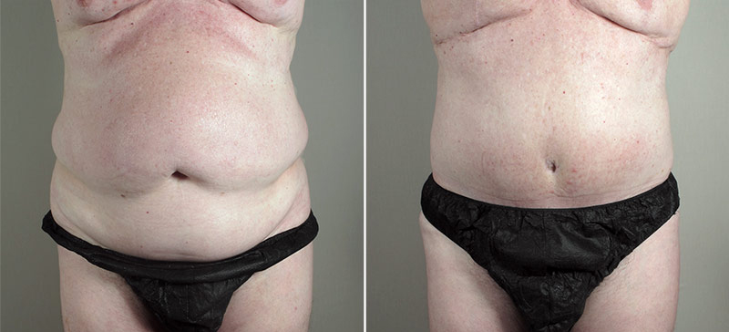 Male Abdominoplasty Patient 9