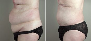 Male Abdominoplasty Patient 9