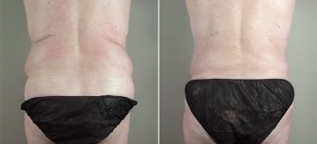 Male Abdominoplasty Patient 9