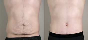 Male Abdominoplasty Patient 10