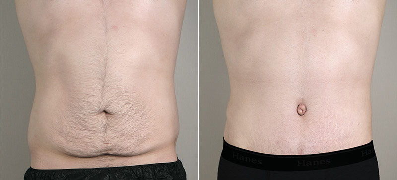 Male Abdominoplasty Patient 10