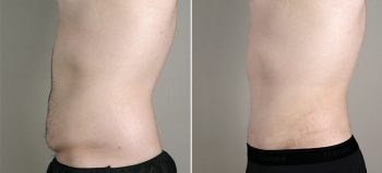 Male Abdominoplasty Patient 10