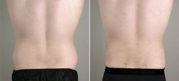 Male Abdominoplasty Patient 10