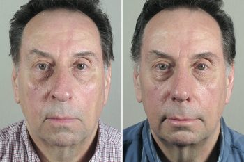 Rhinoplasty & Chin Implant Patient 54