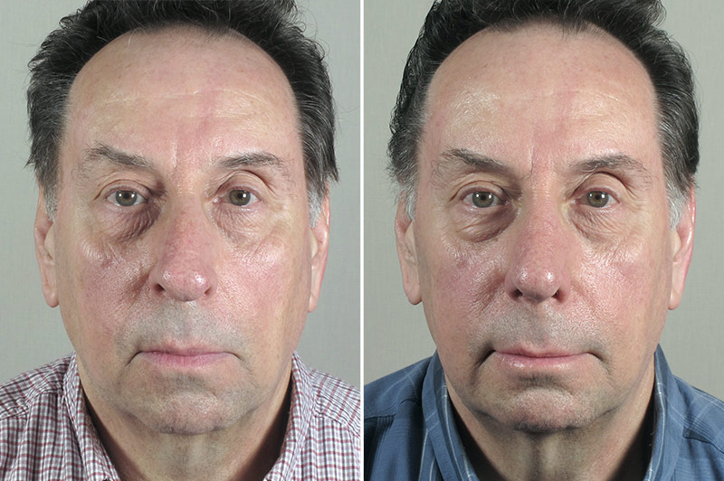 Rhinoplasty & Chin Implant Patient 54