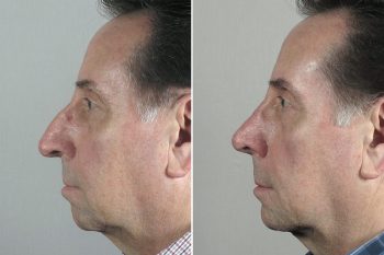 Rhinoplasty & Chin Implant Patient 54